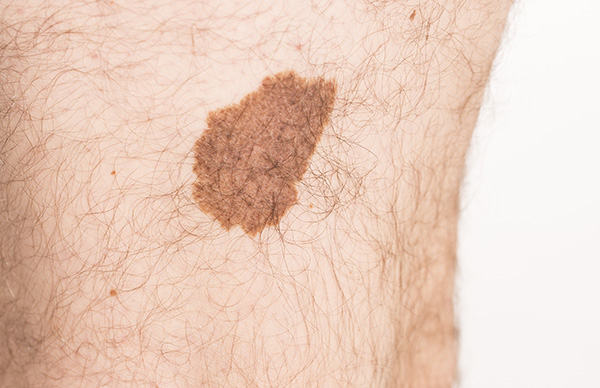melanoma 